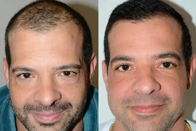 AnyConv.com__male-hair-transplant-dr-jeffrey-epstein-miami-fl-before-after-1750-grafts-1.webp