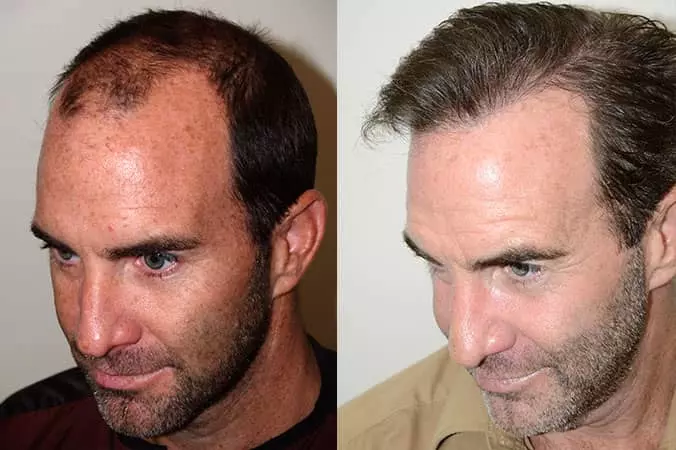 AnyConv.com__male-hair-transplant-dr-jeffrey-epstein-miami-fl-before-after-3200-grafts.webp